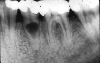 X Rays Teeth Dentistry